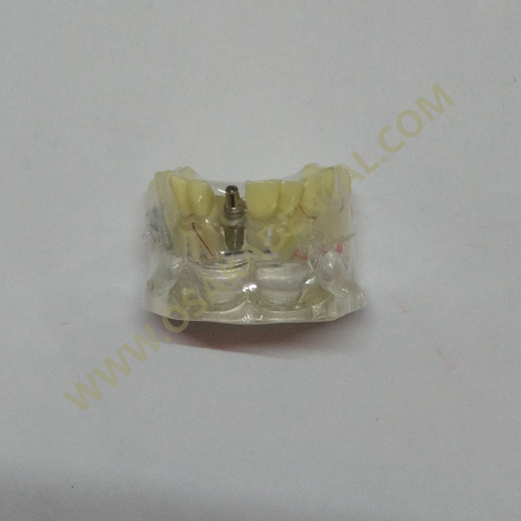 Modelos de implantes dentários OSA-2008a com cárie / modelo de dentes / modelo de dentadura / modelo odontológico / de mão dentária / unidade de cadeira odontológica