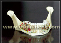 Modelo de ensino para implantes dentários