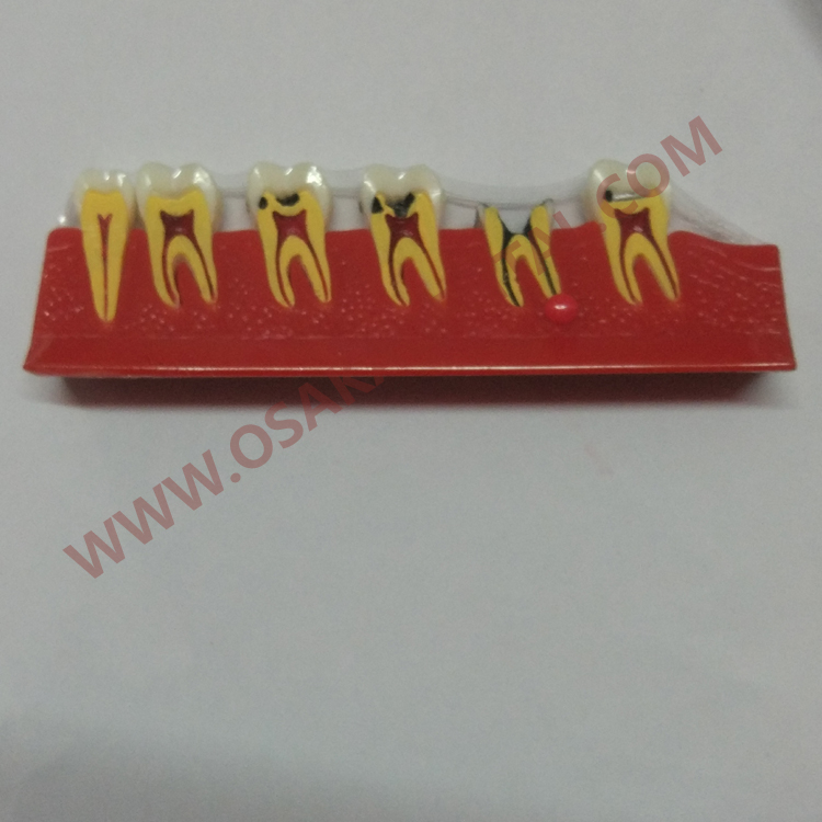 OSA-4011A Cárie dentes forma de modelo de ensino dentário / modelo dentário / de mão dentária / equipamento odontológico