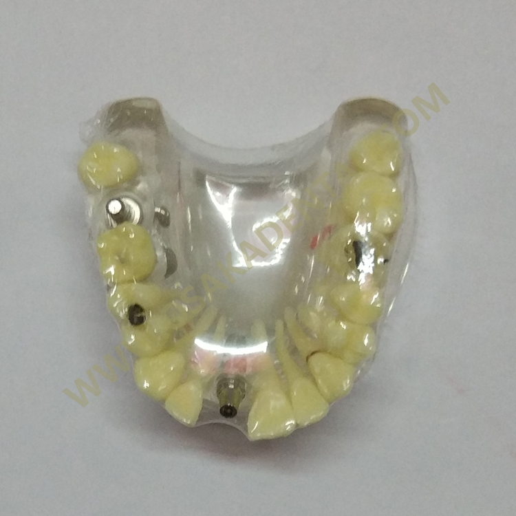 Modelos de implantes dentários OSA-2008a com cárie / modelo de dentes / modelo de dentadura / modelo odontológico / de mão dentária / unidade de cadeira odontológica