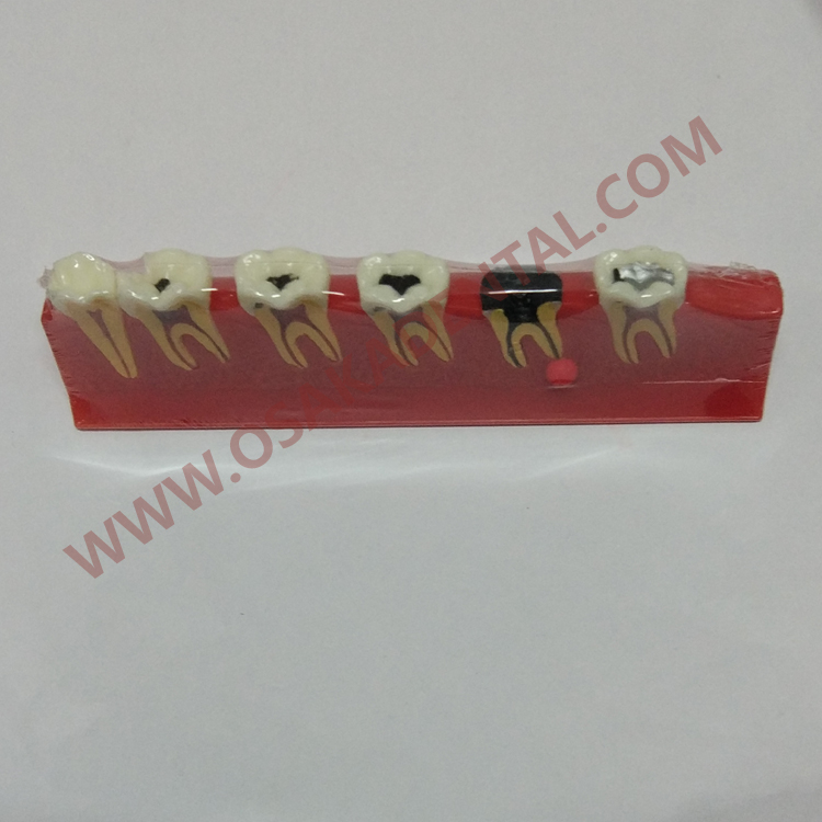 OSA-4011A Cárie dentes forma de modelo de ensino dentário / modelo dentário / de mão dentária / equipamento odontológico