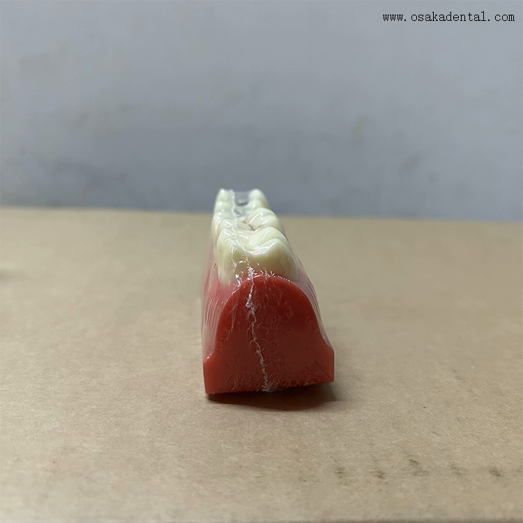 Modelo de demonstração de selante dentário para fossas e fissuras 