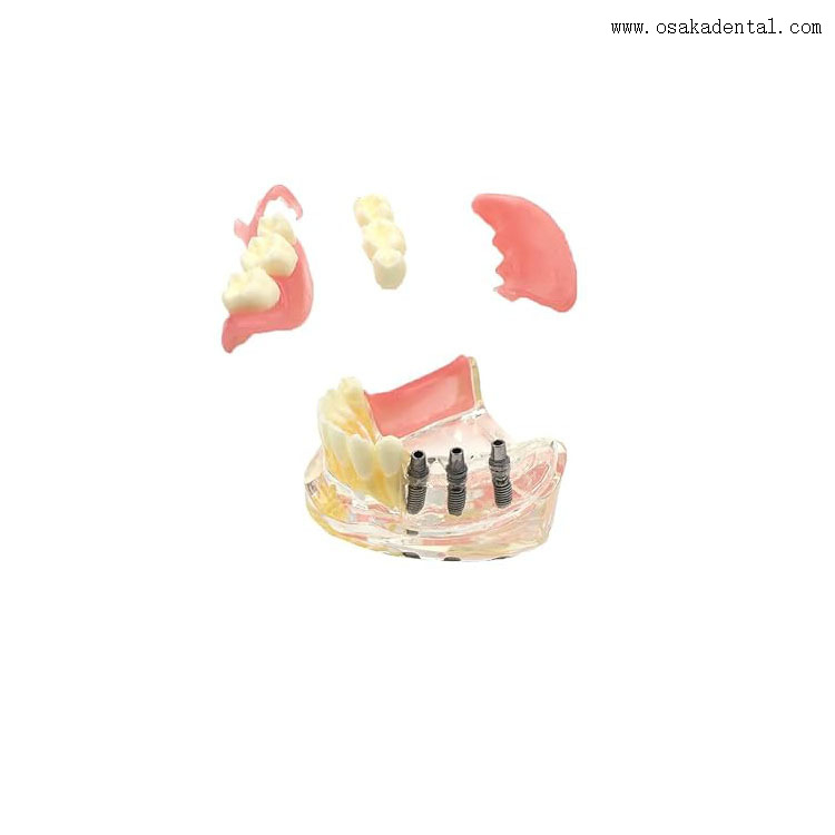 Modelo de comparação de restauração de implantes dentários para ensino de dentistas