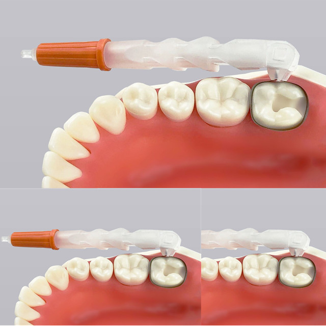 Novo retentor e matriz sem asas dentárias descartáveis