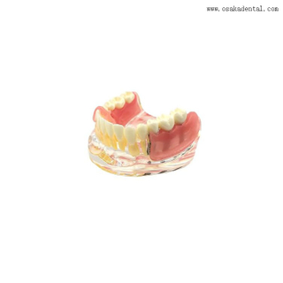 Modelo de comparação de restauração de implantes dentários para ensino de dentistas
