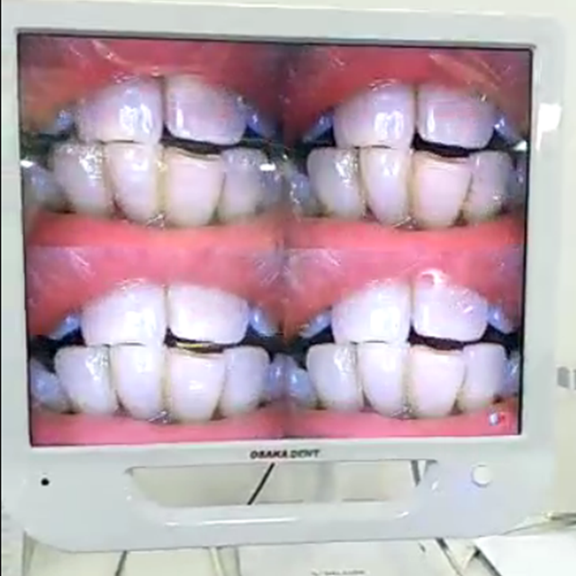 C&acirc;mera odontol&oacute;gica intraoral de 17 polegadas com monitor e suporte de metal.