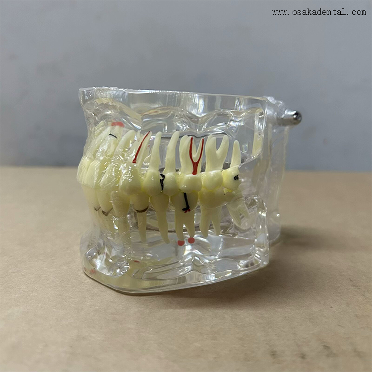 Modelo de patologia dentária para ensino de dentista