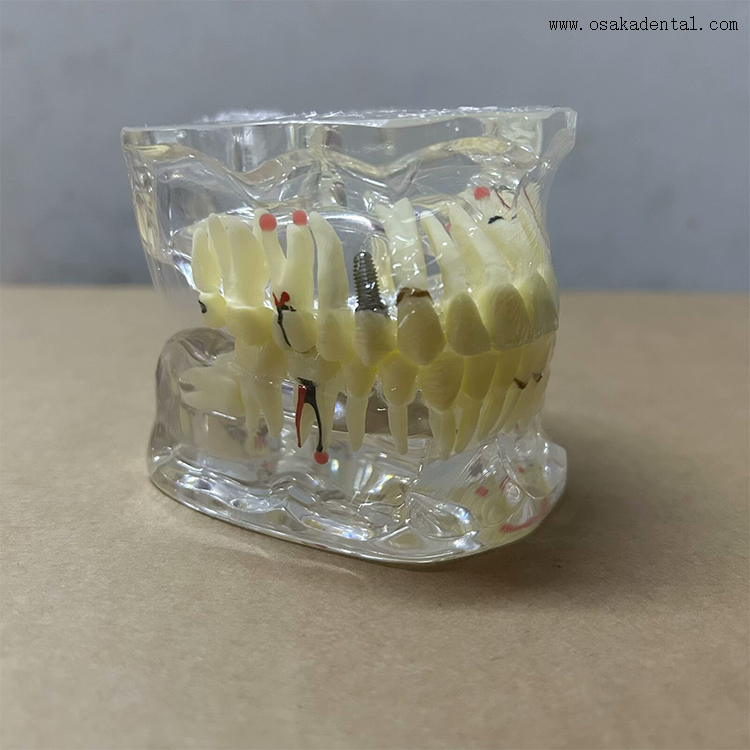 Modelo de patologia dentária para ensino de dentista