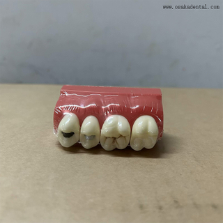Modelo de demonstração de selante dentário para fossas e fissuras 
