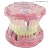 Modelo de implante dentário para ensino de dentista