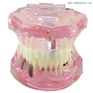 Modelo de implante dentário para ensino de dentista