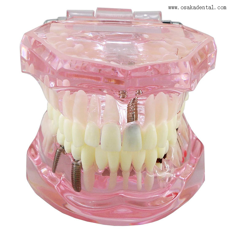 Modelo de implante dentário para ensino de dentista