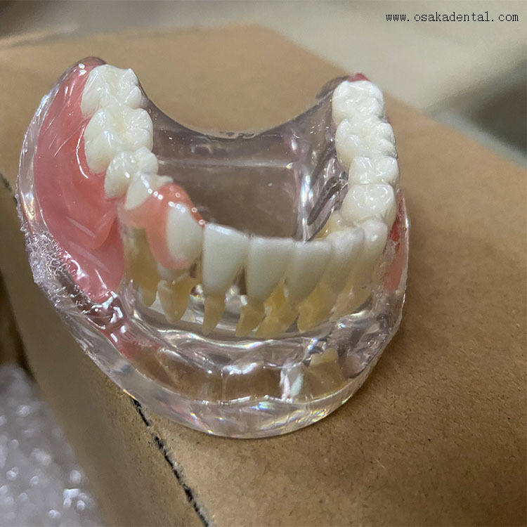 Modelo de comparação de restauração de implantes dentários para ensino de dentistas