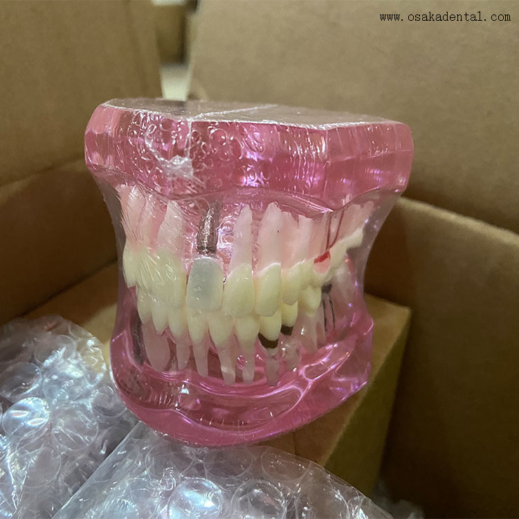 Modelo de implante dentário para ensino de dentista