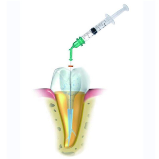 Sistema de Endoirrigação por Pressão Negativa Dentária