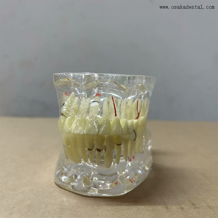 Modelo de patologia dentária para ensino de dentista