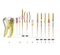 Niti ProTAPER Golden Heat Ativation Dental Arquivo